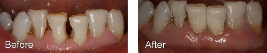 A before and after picture of a person's teeth.