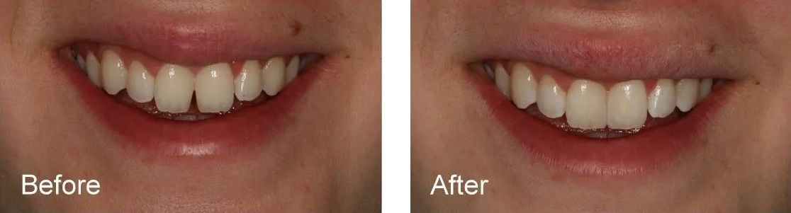 A before and after picture of a person's smile.