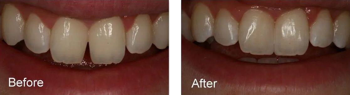 A before and after picture of a person's teeth.