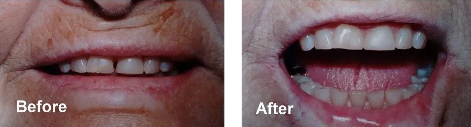 A before and after photo of a woman's teeth.