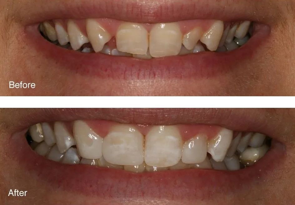 A before and after picture of a person's teeth.