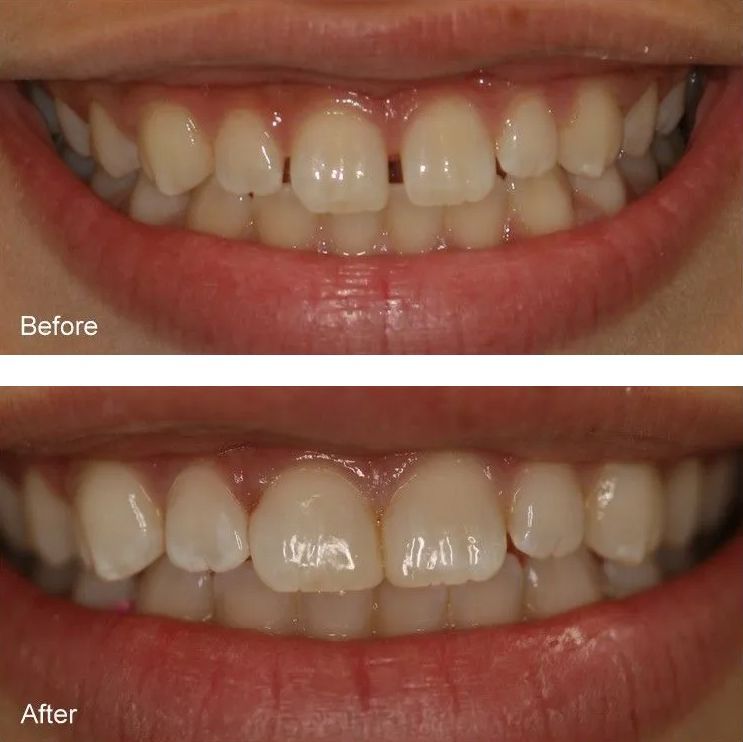 A before and after picture of a person's teeth.