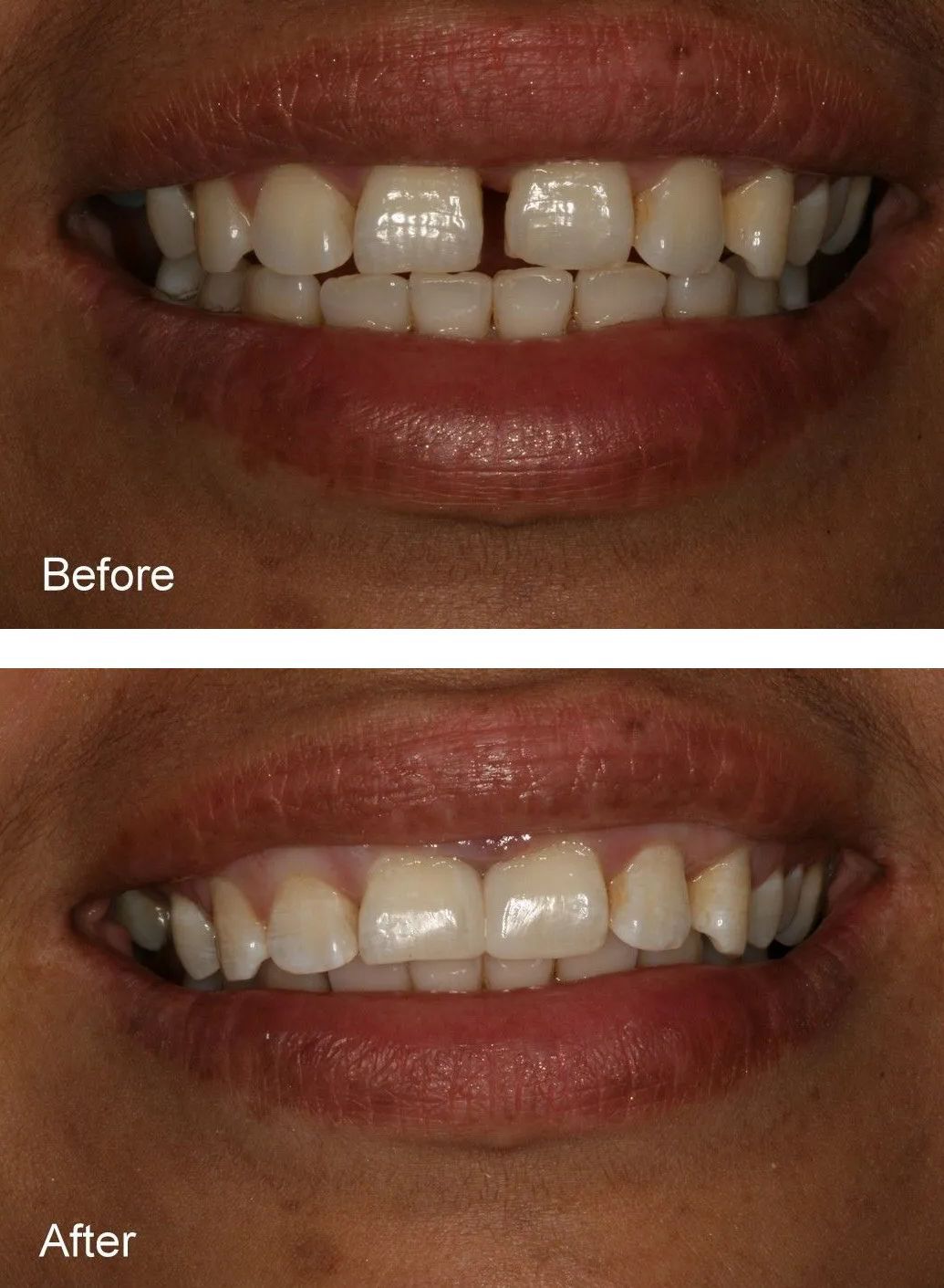 A before and after picture of a person's teeth.
