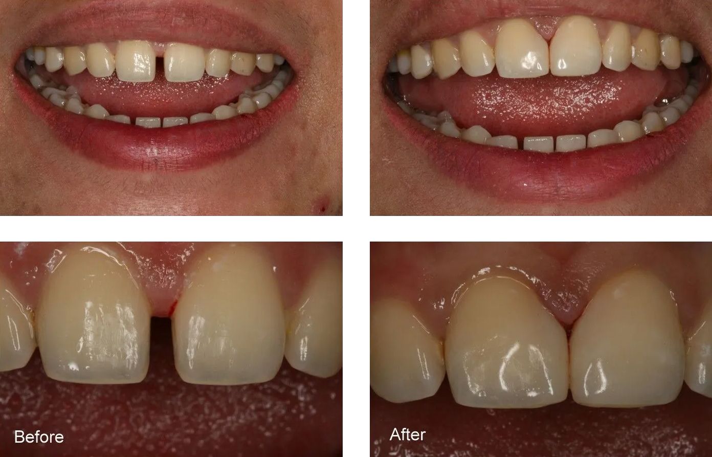 A before and after picture of a person's teeth.