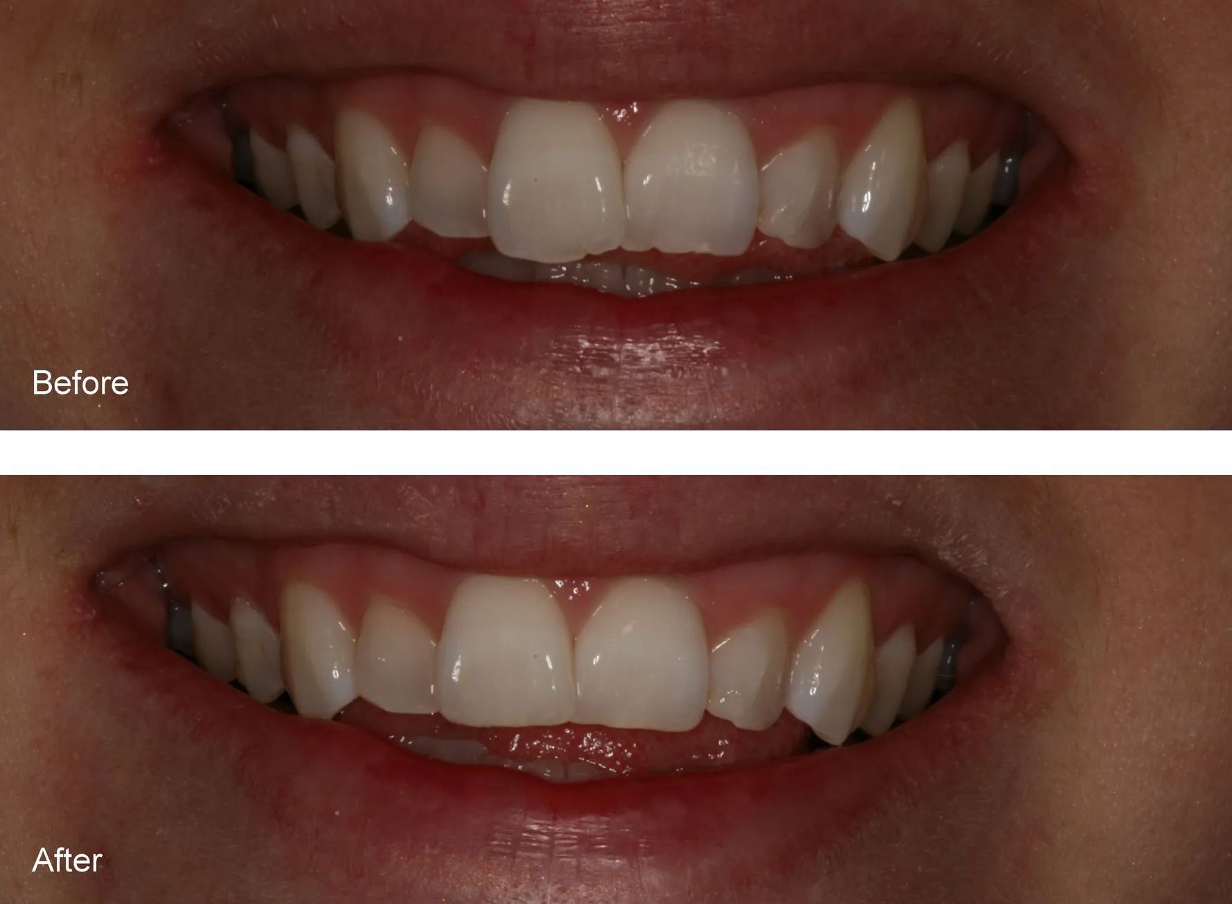 A before and after picture of a person's teeth.