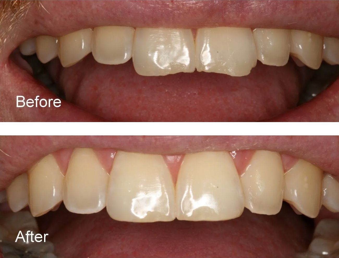 A before and after picture of a person's teeth.