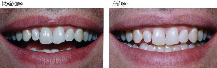 A before and after picture of a man's teeth.