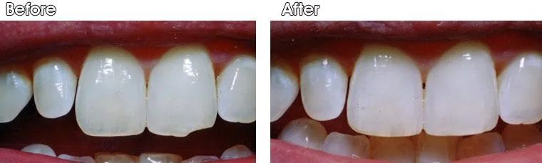 A before and after picture of a person's teeth.