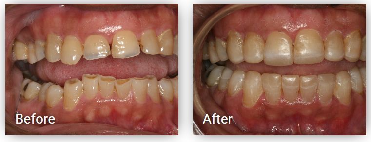 A before and after picture of a person 's teeth
