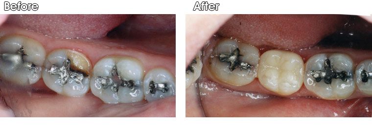 A before and after picture of a person's teeth.