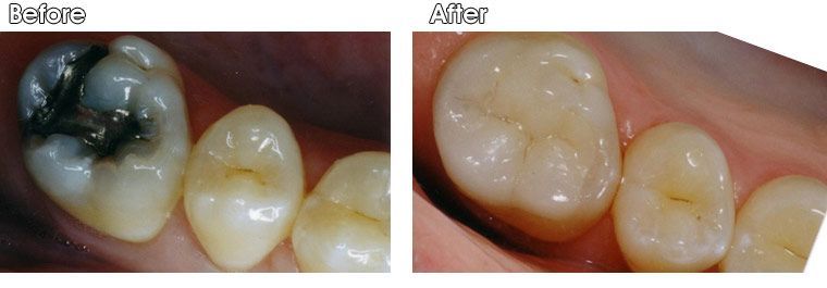 A before and after picture of a person's teeth.