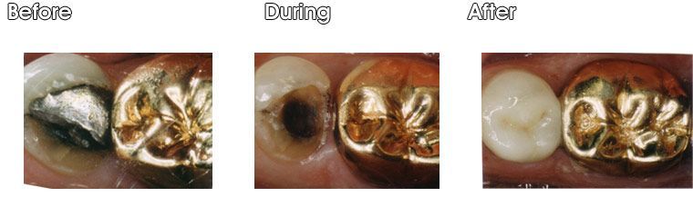 Before, during and after photos of a person's teeth