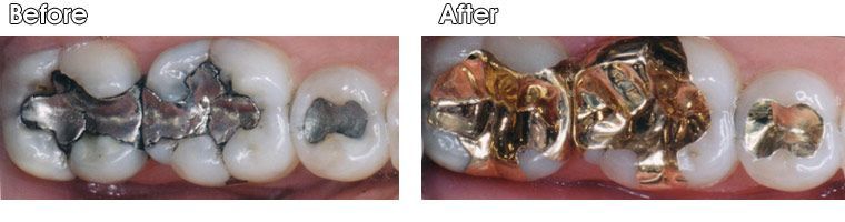 Before and after photos of a person's teeth