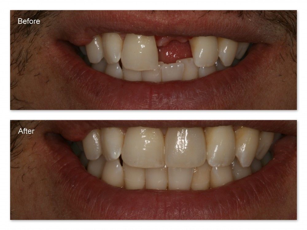 A before and after picture of a man 's teeth