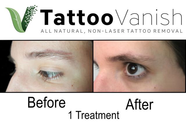 Before  Afters  Vanish Tattoo Removal Before  After Images