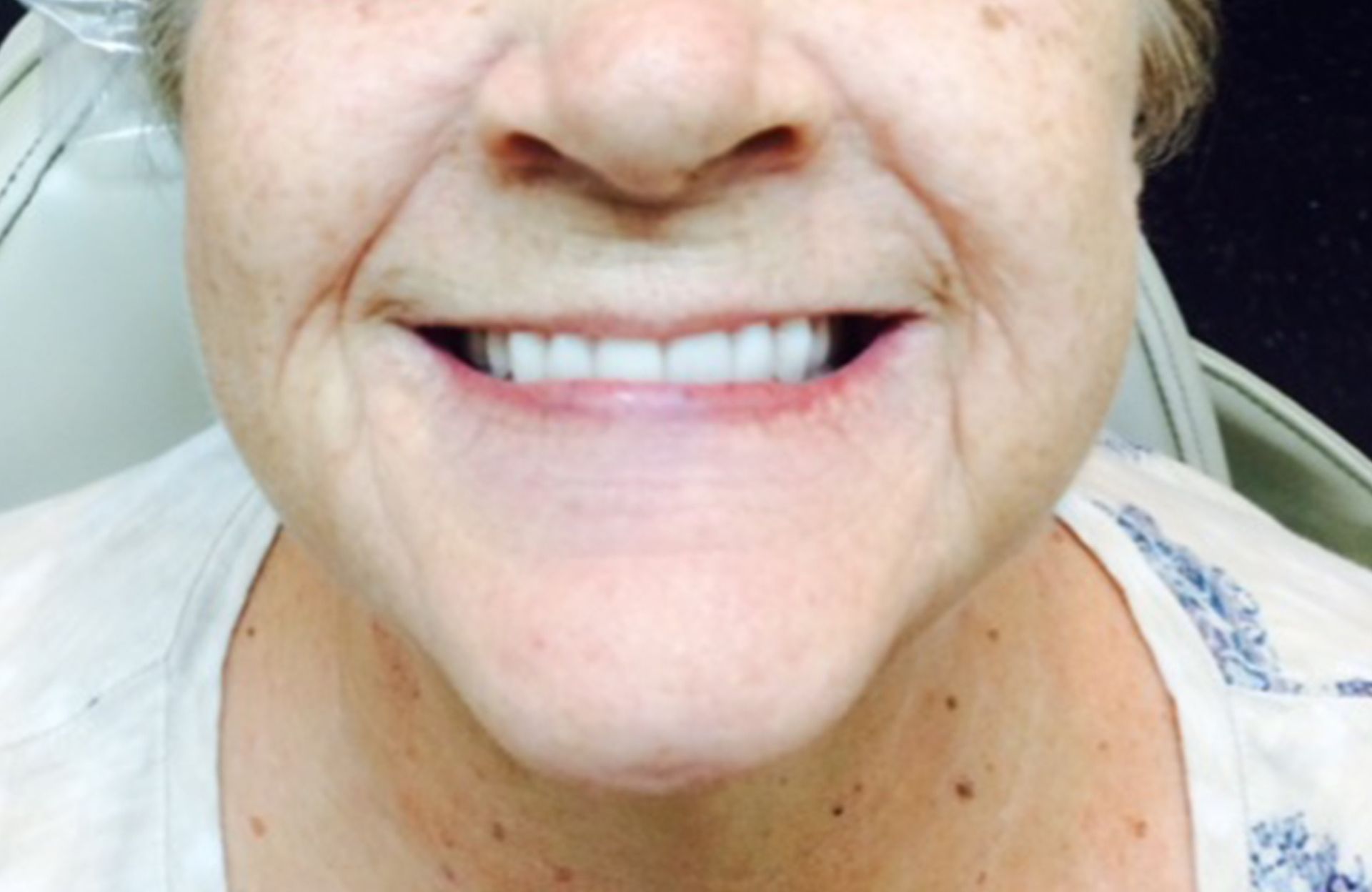 Close-up of a smiling person’s mouth and chin, showing white teeth and smooth skin