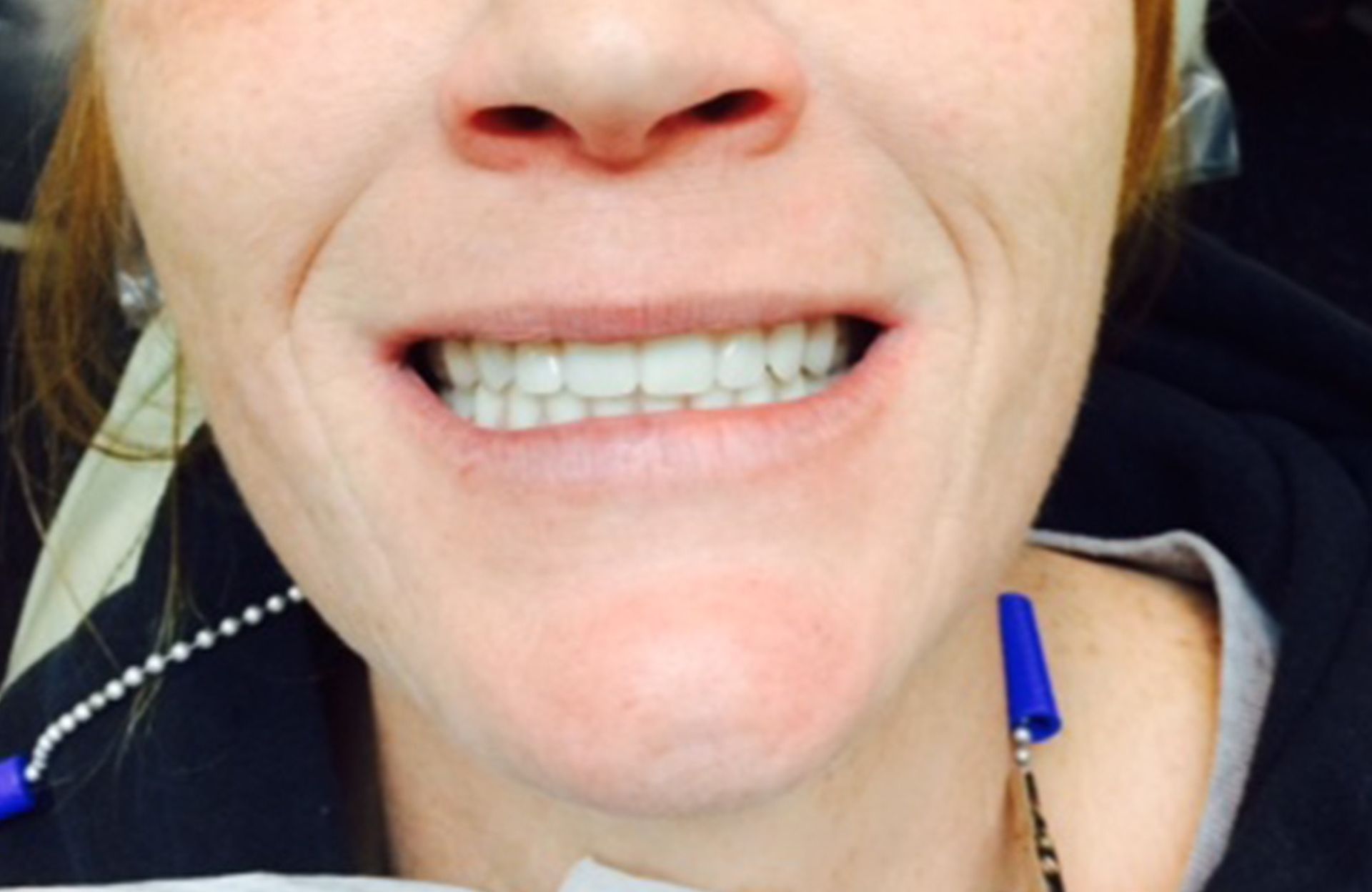 Close-up of a person smiling, showing teeth with braces and blue earpieces visible against a dark background