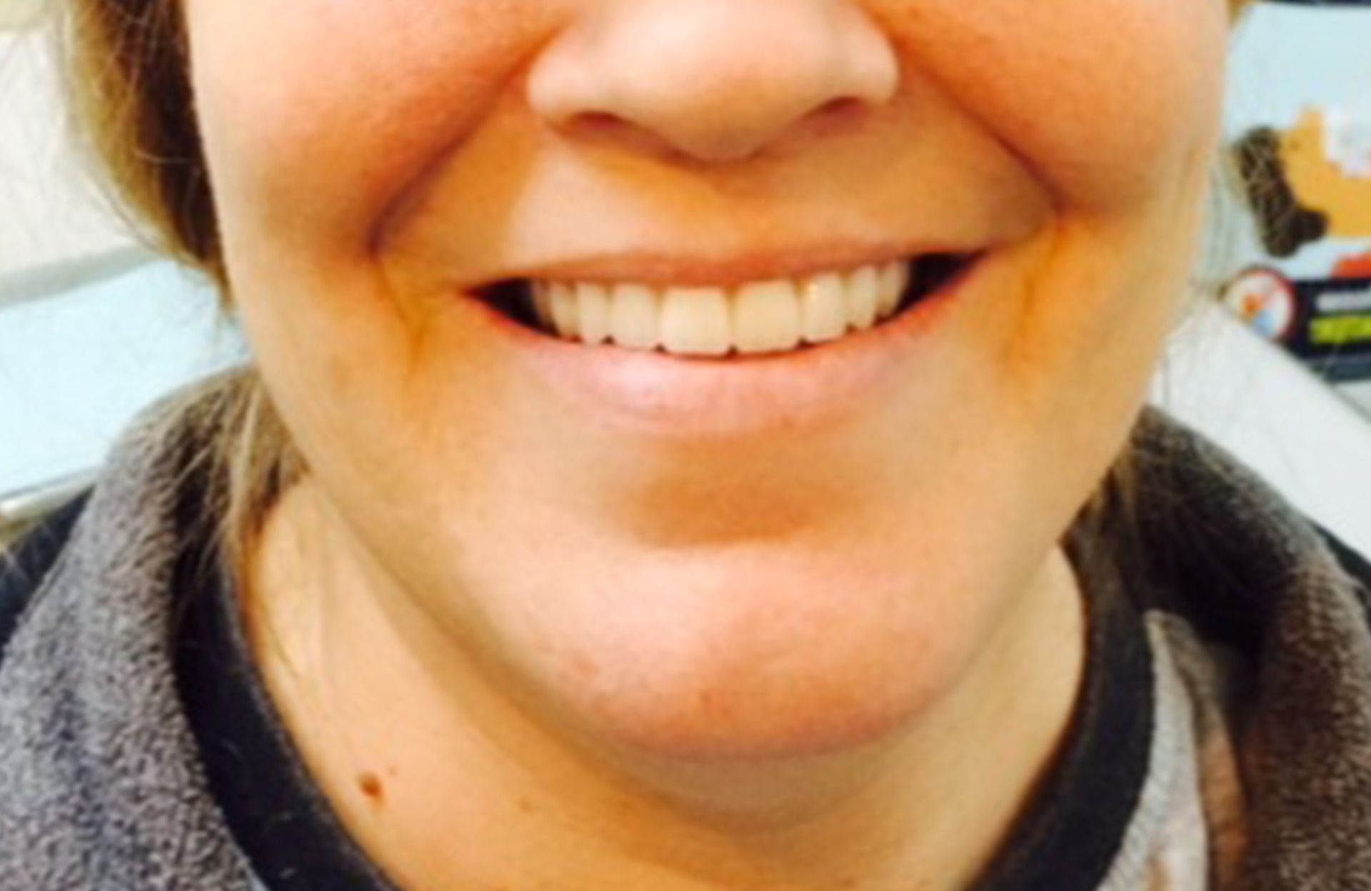 Close-up of a smiling mouth and lower face in a gray jacket