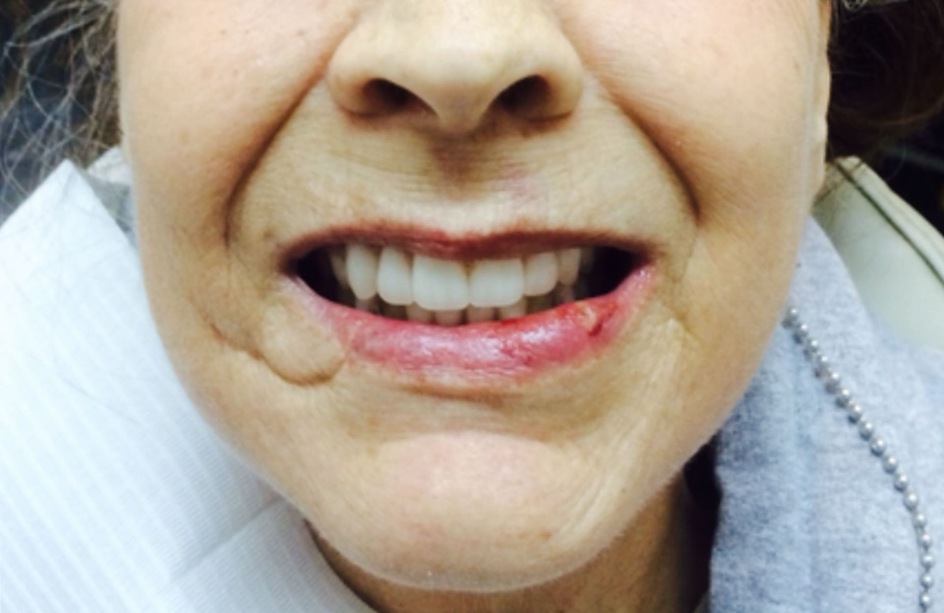 Close-up of a smiling mouth showing a gap in the lower lip and teeth