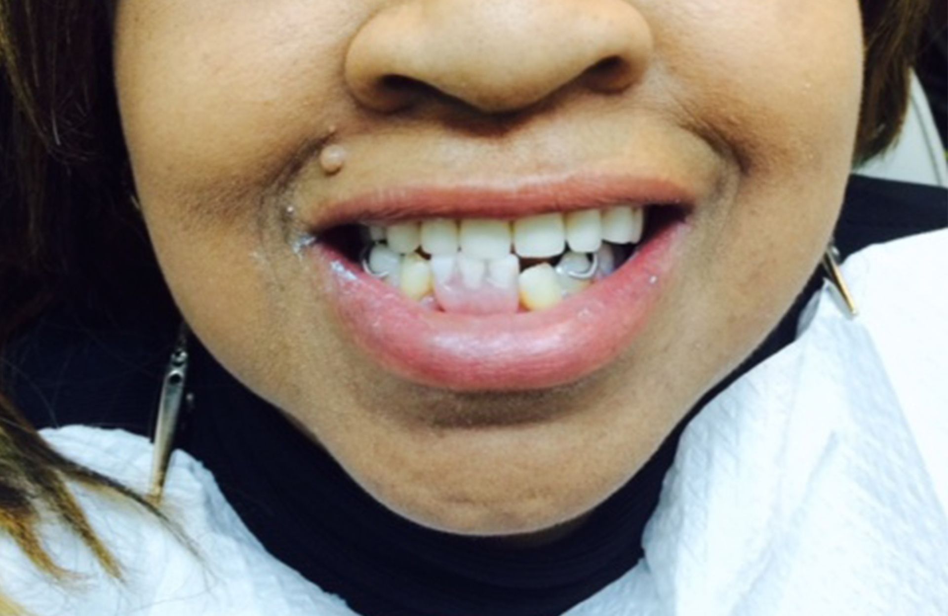 Close-up of a smiling mouth showing crooked, yellowed teeth and braces remnants