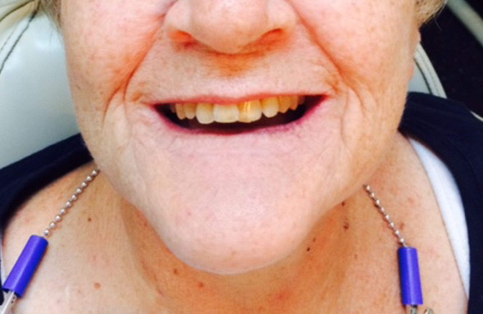 Close-up of a smiling mouth and chin with two blue pen-like devices hanging from a necklace