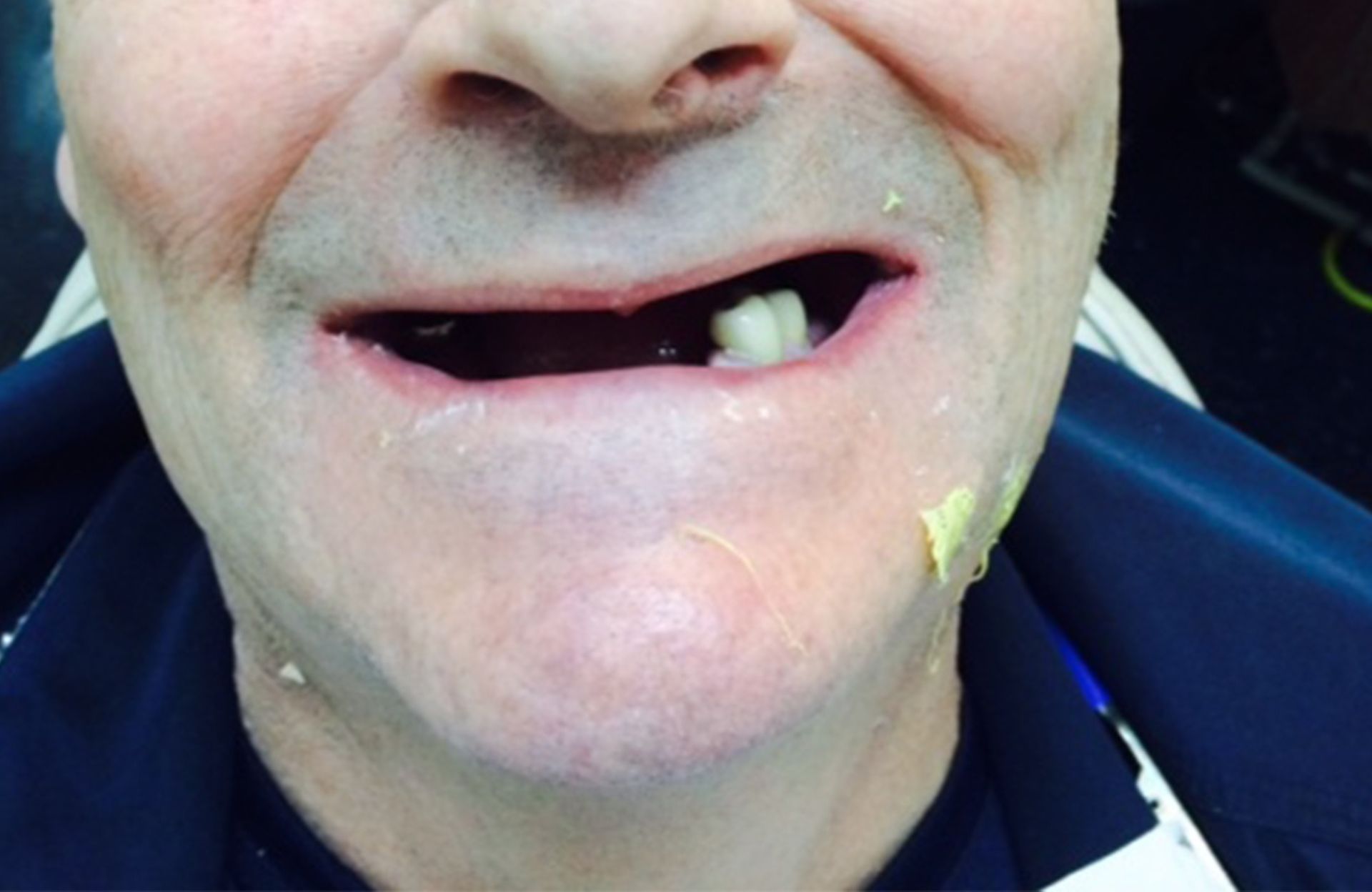Close-up of a smiling face with mouth open and a missing tooth, against a dark background