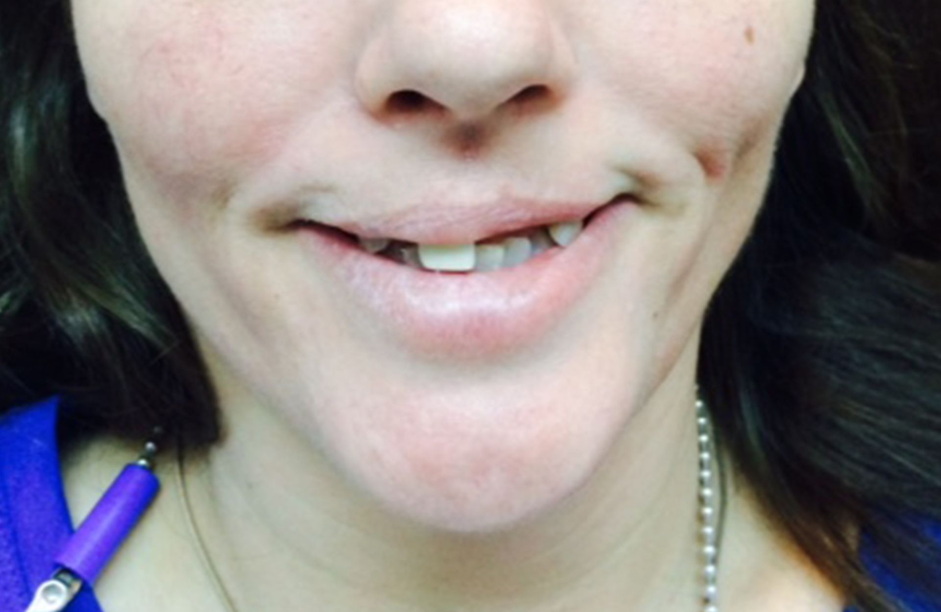 Close-up of a smiling mouth and chin, with a purple pen pointing near the lower lip.