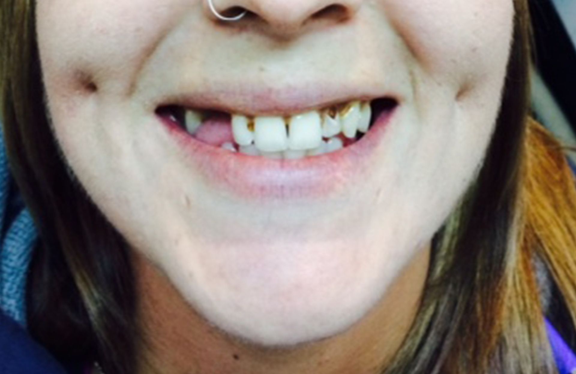 Close-up of a smiling mouth showing missing and chipped front teeth, with a nose ring visible.