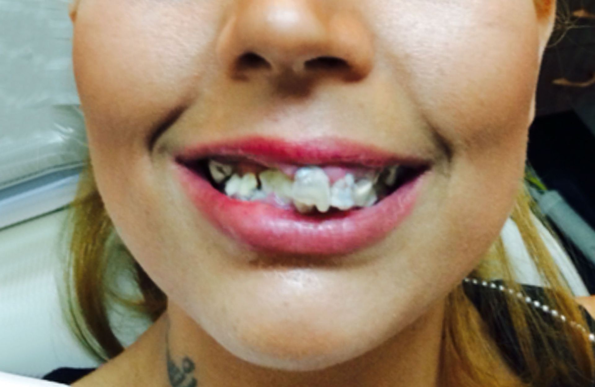 Close-up of a smiling mouth with pink lipstick and braces on the teeth
