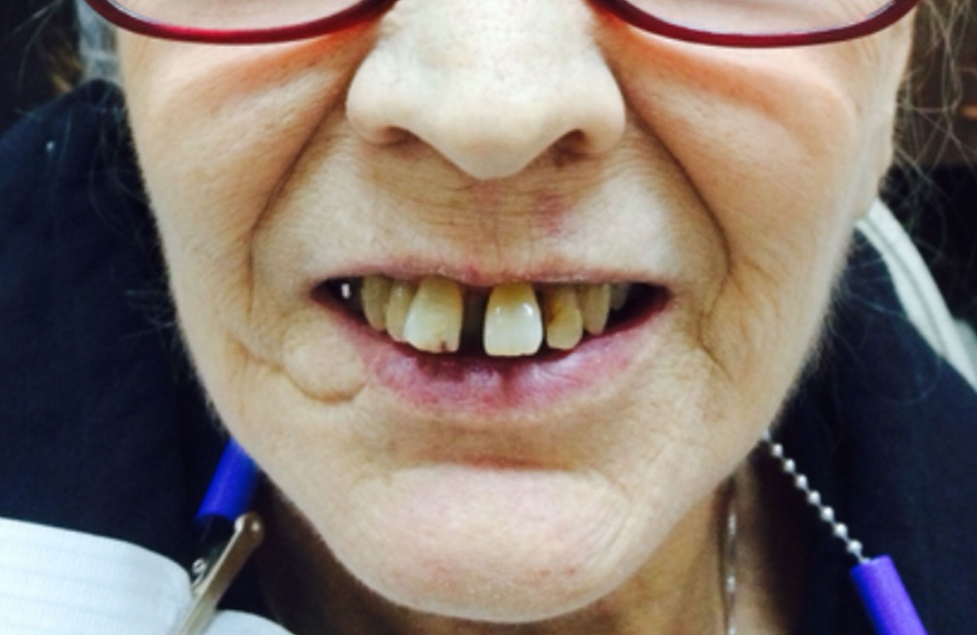 Close-up of a person with red glasses showing missing and crooked front teeth.