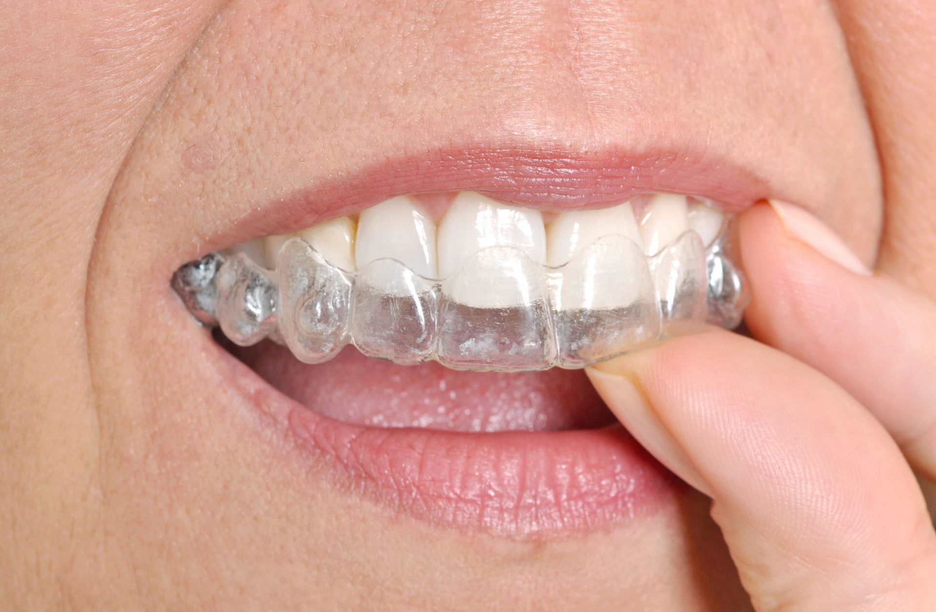Close-up of a mouth fitting a clear dental aligner over upper teeth