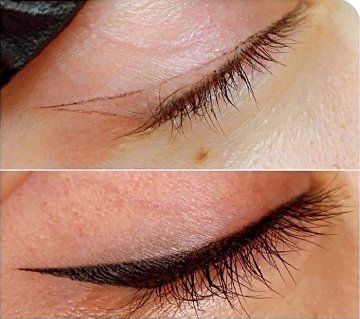 eye liner micropigmentation