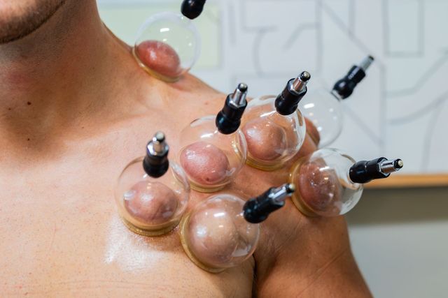 Cupping | Chinese Medicine | West Des Moines, IA