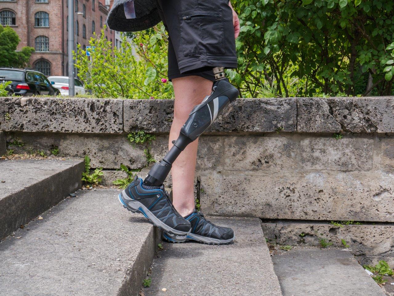 Above Knee Prosthetics