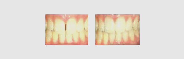 Minor Tooth Movement