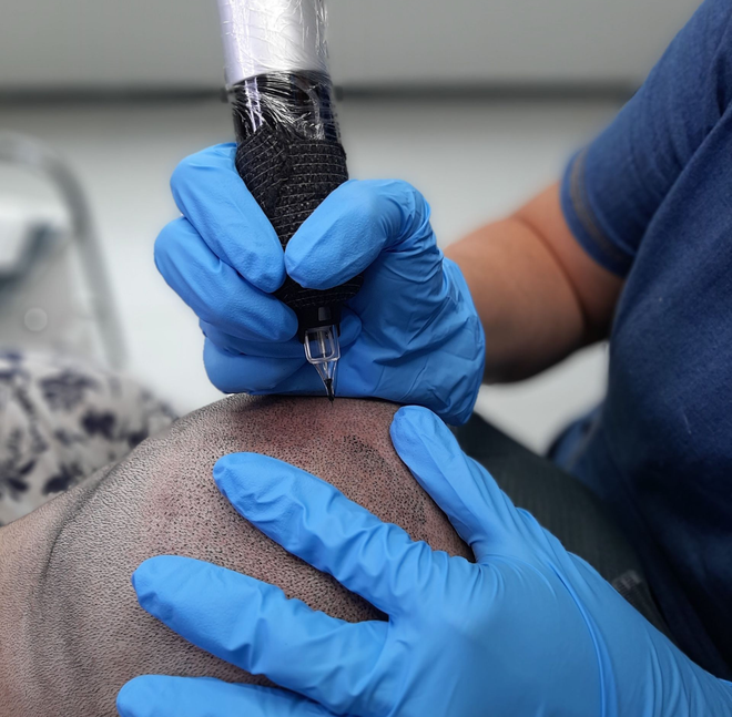 Blue-gloved hands tattooing a shaved scalp with a handheld machine