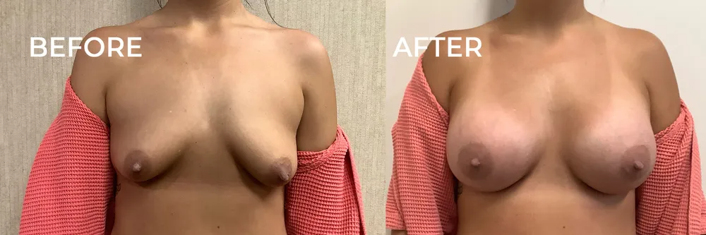A comparison of breasts before and after a procedure. The 