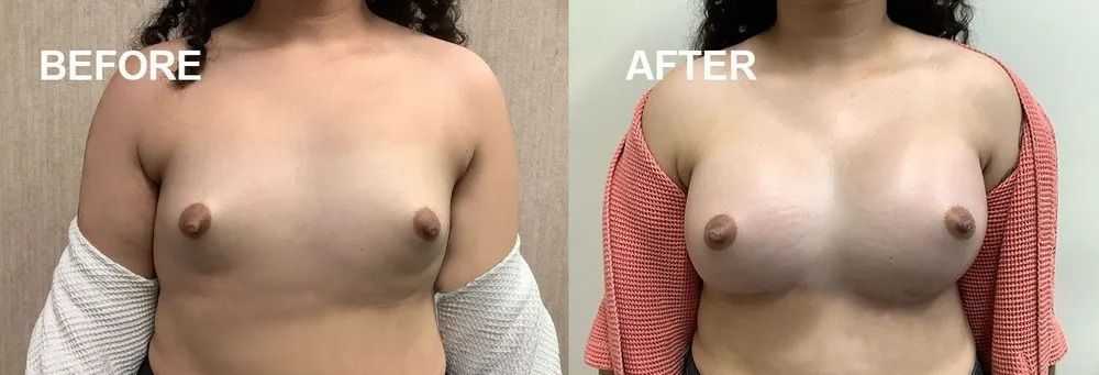 A comparison showing a person’s breasts before and after a procedure.