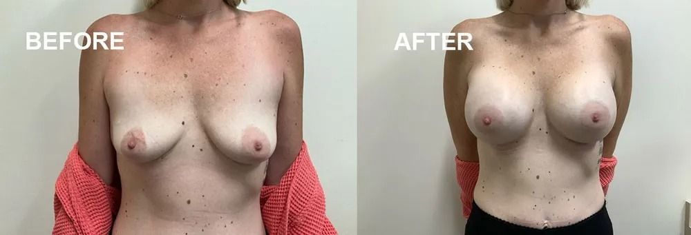 Comparison of a woman's breasts 