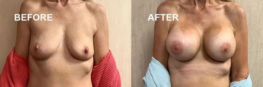 Comparison of breasts before and after surgery.