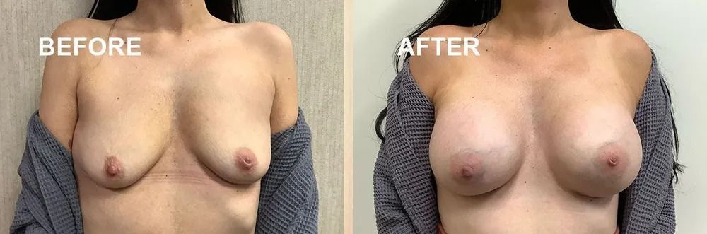 Side-by-side comparison of a person's chest labeled 