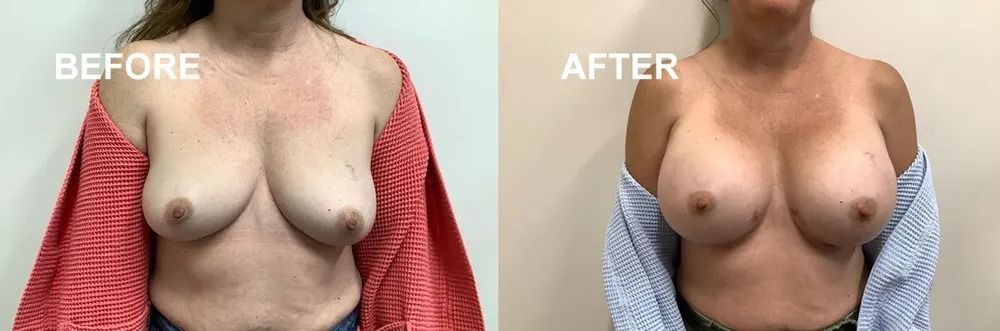 Side-by-side comparison of breasts before and after surgery.