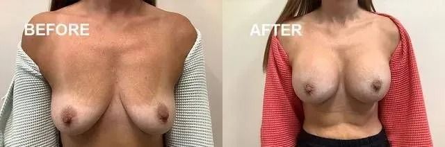 Side-by-side comparison. Before: small breasts. After: breasts are enlarged with nipple piercings.
