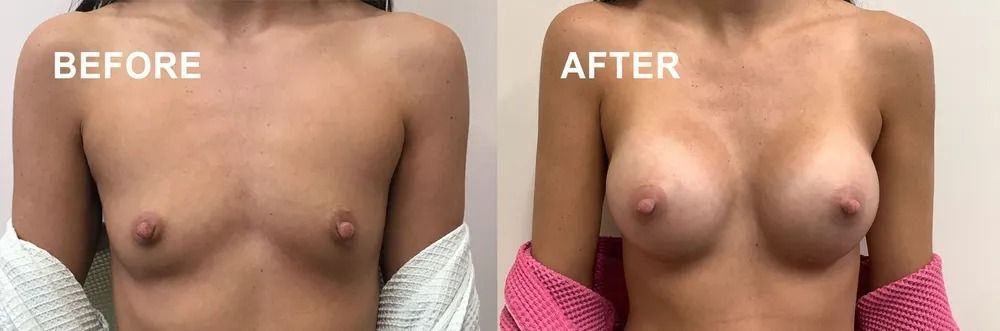 Before and after breasts comparison. Breasts are more full and shapely in the after photo.