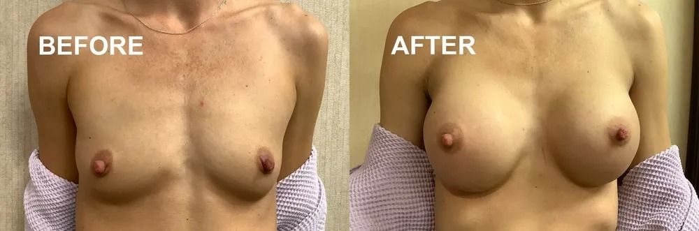 Comparison of a person's chest before and after a procedure; chest appears fuller and rounder in the 
