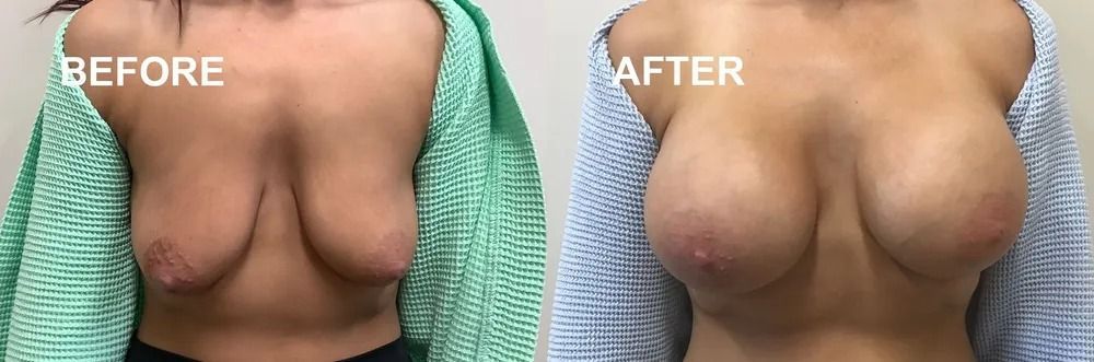 Breast augmentation before and after. The 