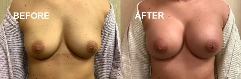 Comparison of breasts before and after surgery.