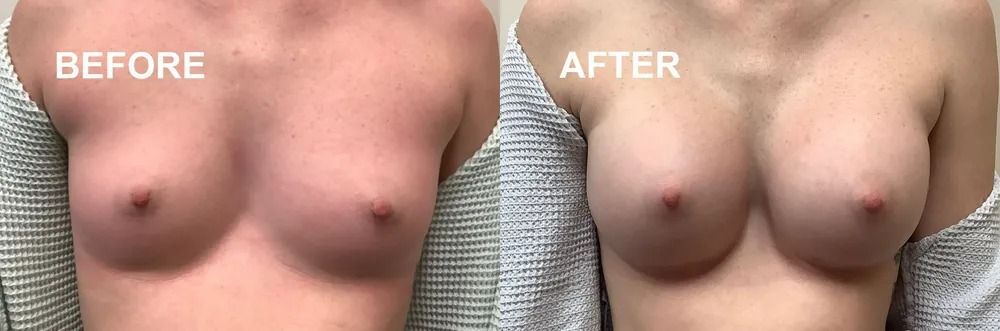 A split image showing a chest with nipples. 