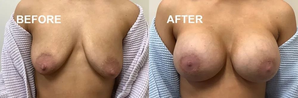 Before and after comparison of a person's breasts; the 
