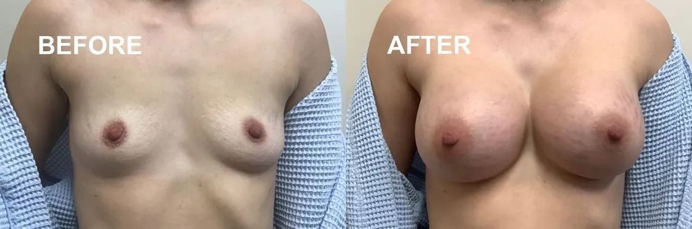 Comparison of a person's chest before and after a cosmetic procedure. The 